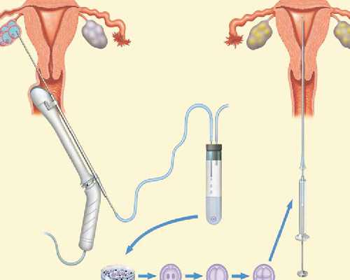 供卵广告是假的吗_国内供卵试管婴儿,山大生殖医院供卵试管(山大生殖供卵怎么